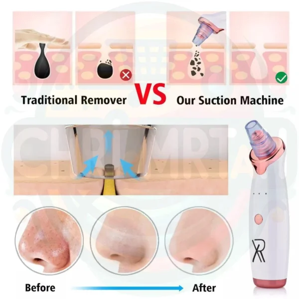 Blackhead Remover